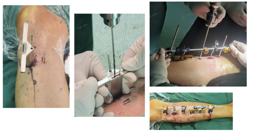 Transverse Tibial Bone Transport 