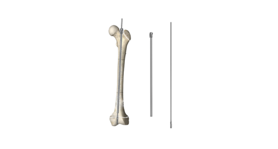 Pediatric Telescopic lntramedullary Nail