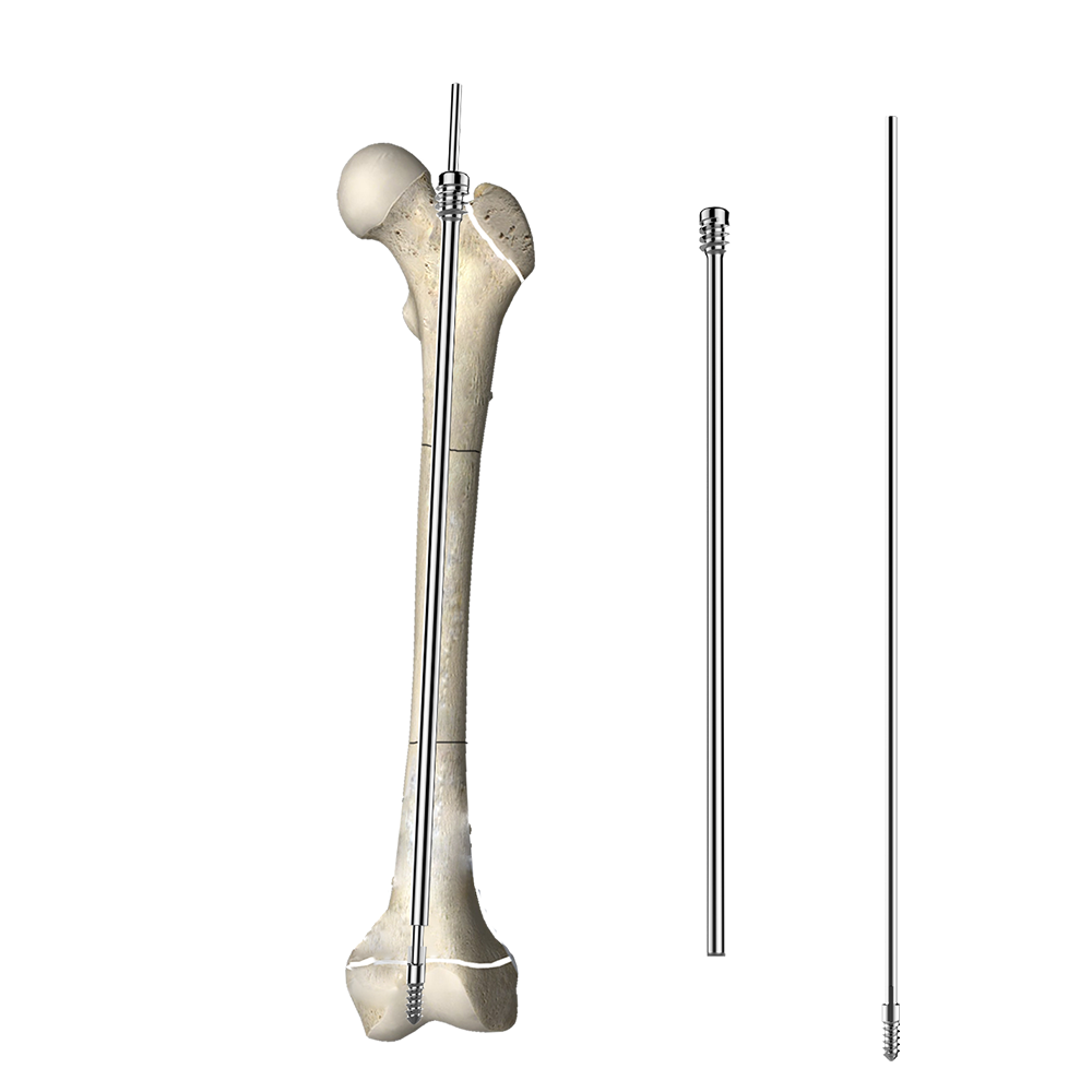 Telescopic Intramedullary Nail