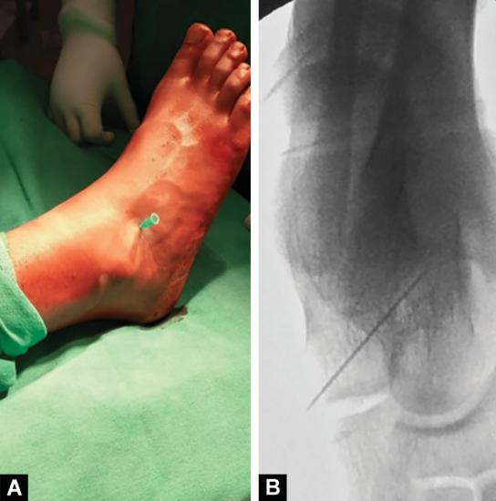 pediatric flat foot