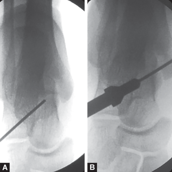 tarsal sinus screw