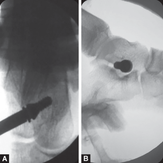 Sinus Tarsi implant