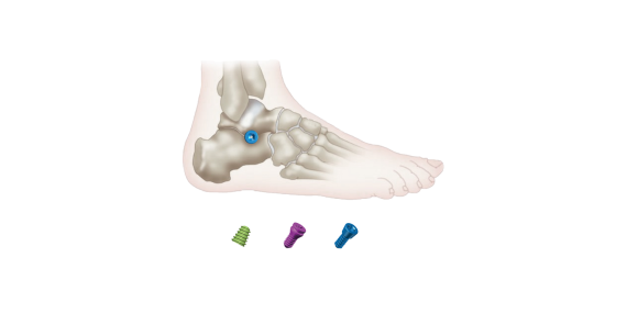 Extra-Osseous Talotarsal Stabilization (EOTTS) on Flat Foot Correction