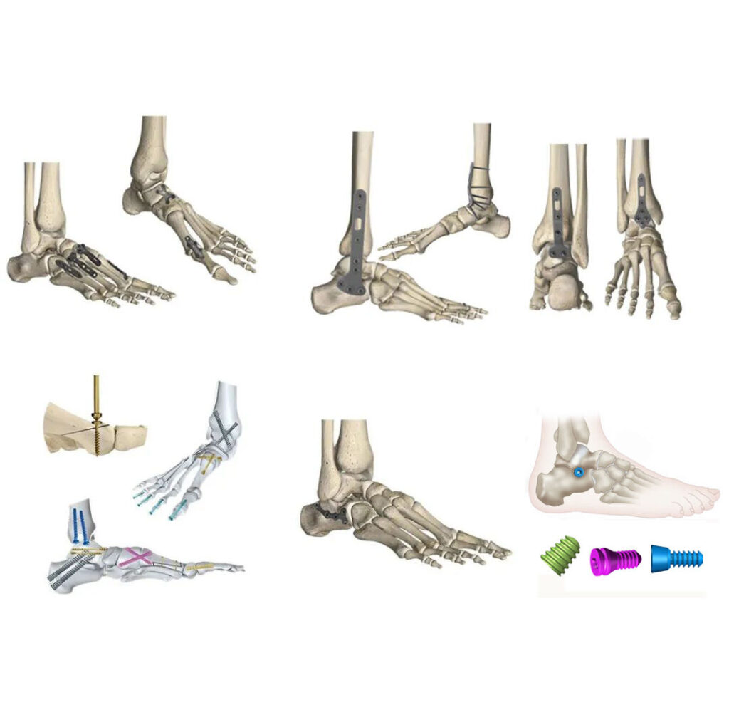 Forefoot Midfoot Hindfoot  Ankle Implant