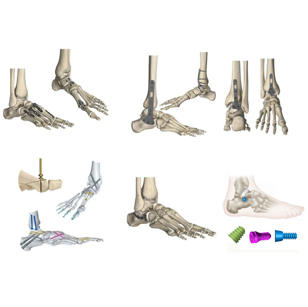 Forefoot Midfoot Hindfoot Ankle Implant