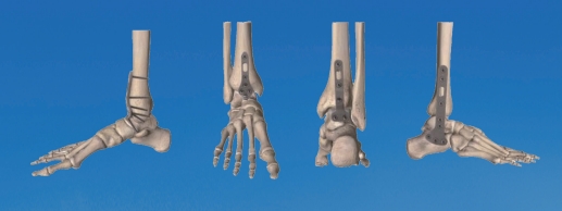 Ankle Joint Fusion Locking Plate