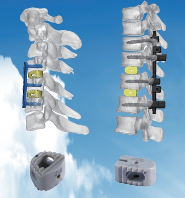 Thoracolumbar Spinal System