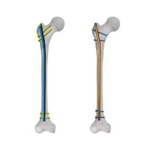 Child Femoral Interlocking Nail