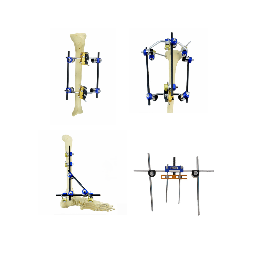 hoffmann fixator