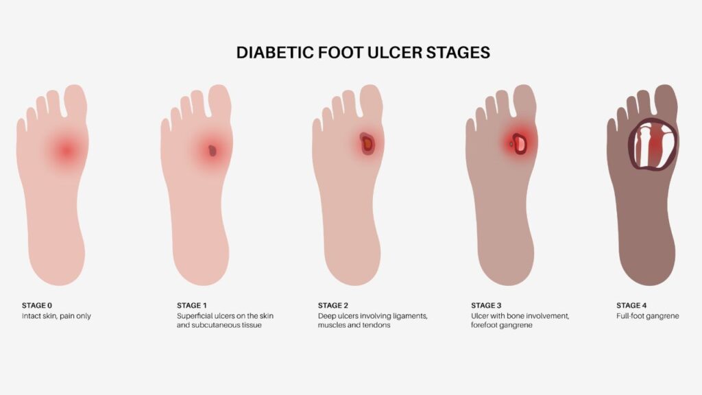 Diabetic Foot Ulcer