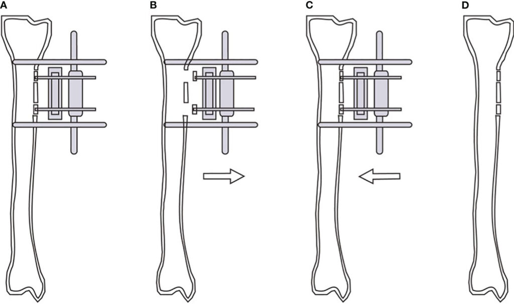 Transverse Tibial Bone Transport surgery