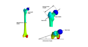 Femoral Neck-Shaft Angle and Femoral Neck Anteversion-2