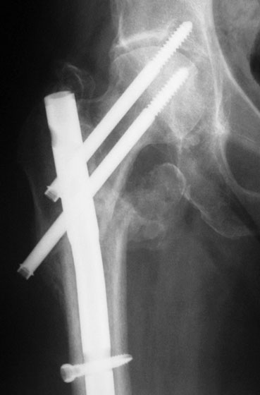 Z-effect after intramedullary nailing systems for trochanteric femur fractures 1