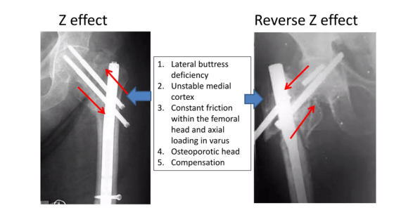 Z-effect after intramedullary nailing systems for trochanteric femur fractures