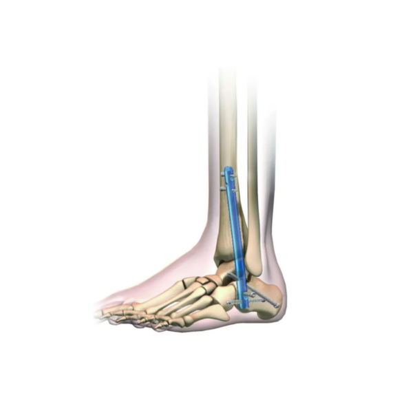 Intramedullary Nail for Ankle Arthrodesis