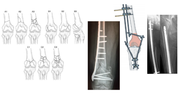 An Overview of Options in Distal Femur Fractures