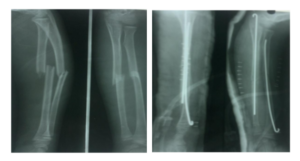 Home 12 Intramedullary Stainless Steel Rush Pins for Pediatric Diaphyseal Forearm Fractures