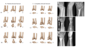 Ukraine 13 A Reliable Surgical Strategy for AO Type C3 Distal Radius Fractures Distal Radius Fixator with LCP Volar Distal Radius Plate
