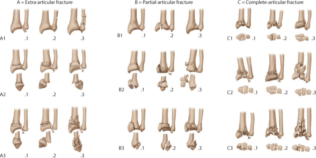 AO classification of fractures of the distal radius