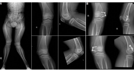 Eight-Plate vs. Reconstruction Plate in Pediatric Guided Growth