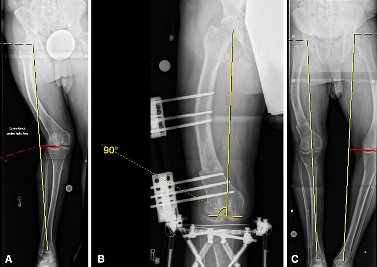 External Fixation (Unilateral Frame)