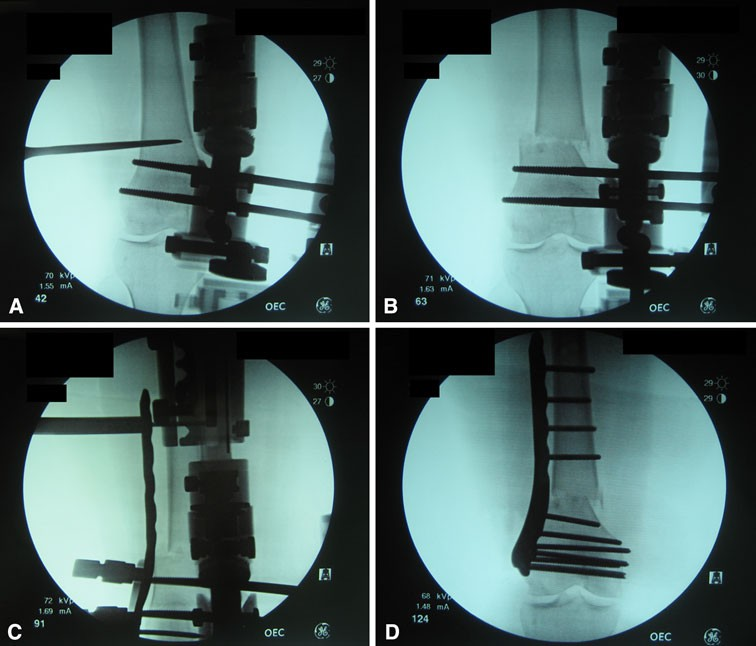 Internal Fixation(Fixator-Assisted Plating)