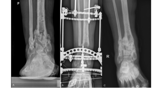 Understanding NonUnion of Long Bone Fractures & How to Choose Between Ilizarov and MonoRail Fixators