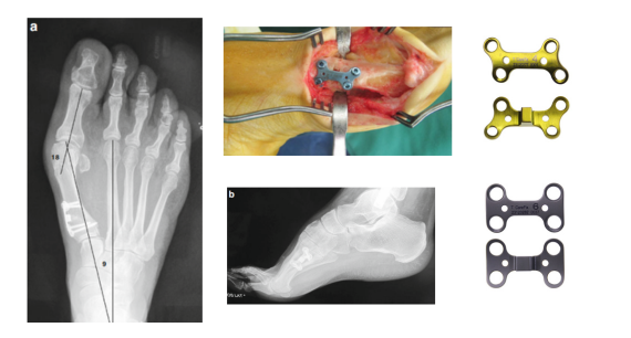 Opening Wedge Locking Plate in Metatarsal Osteotomy