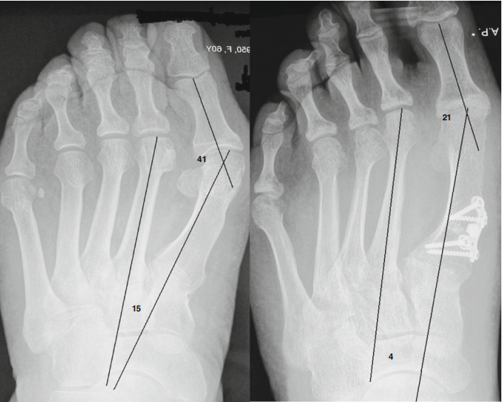 Opening Wedge Locking Plate in Metatarsal Osteotomy 3