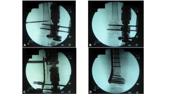 Optimizing Outcomes in Distal Femoral Osteotomy