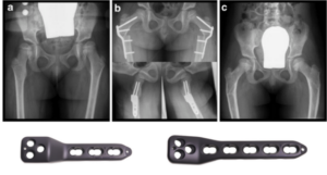 Paediatric Hip Plate