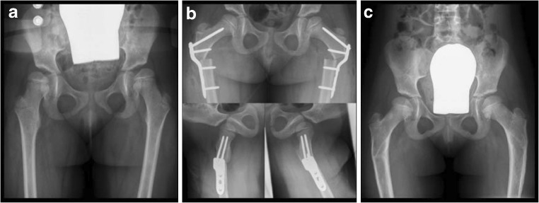 Paediatric Hip Plate Case 1