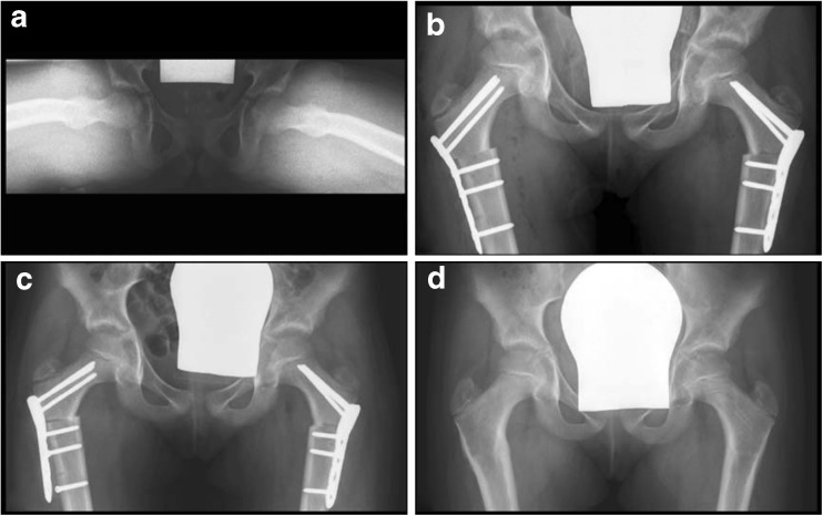 Paediatric Hip Plate Case 2