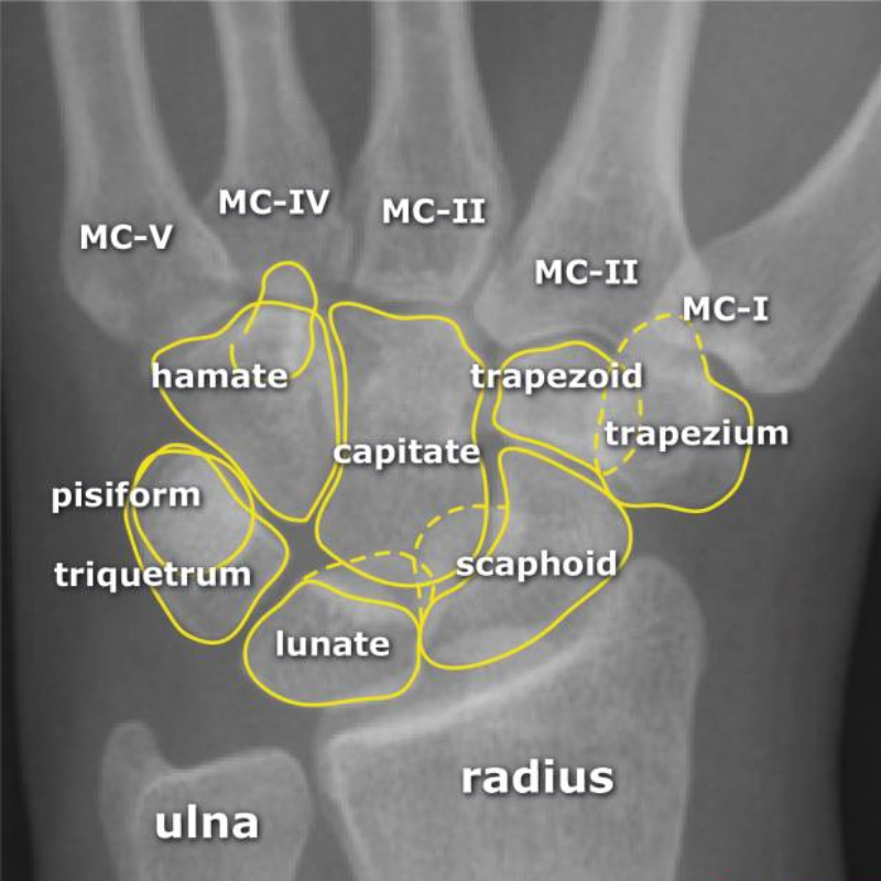 Anatomy and Frequency of Carpal Fractures