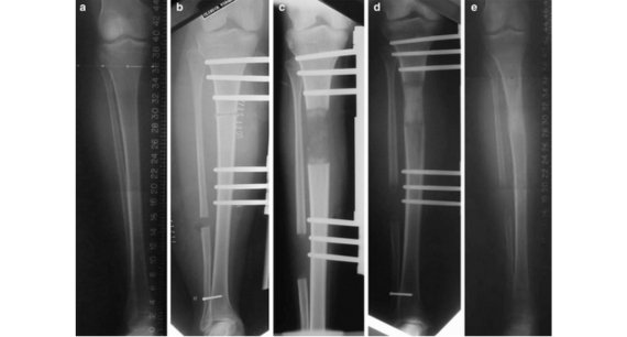 Mastering Callotasis The Science and Strategy of Bone Lengthening
