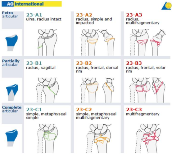Distal Radius AO OTA classification