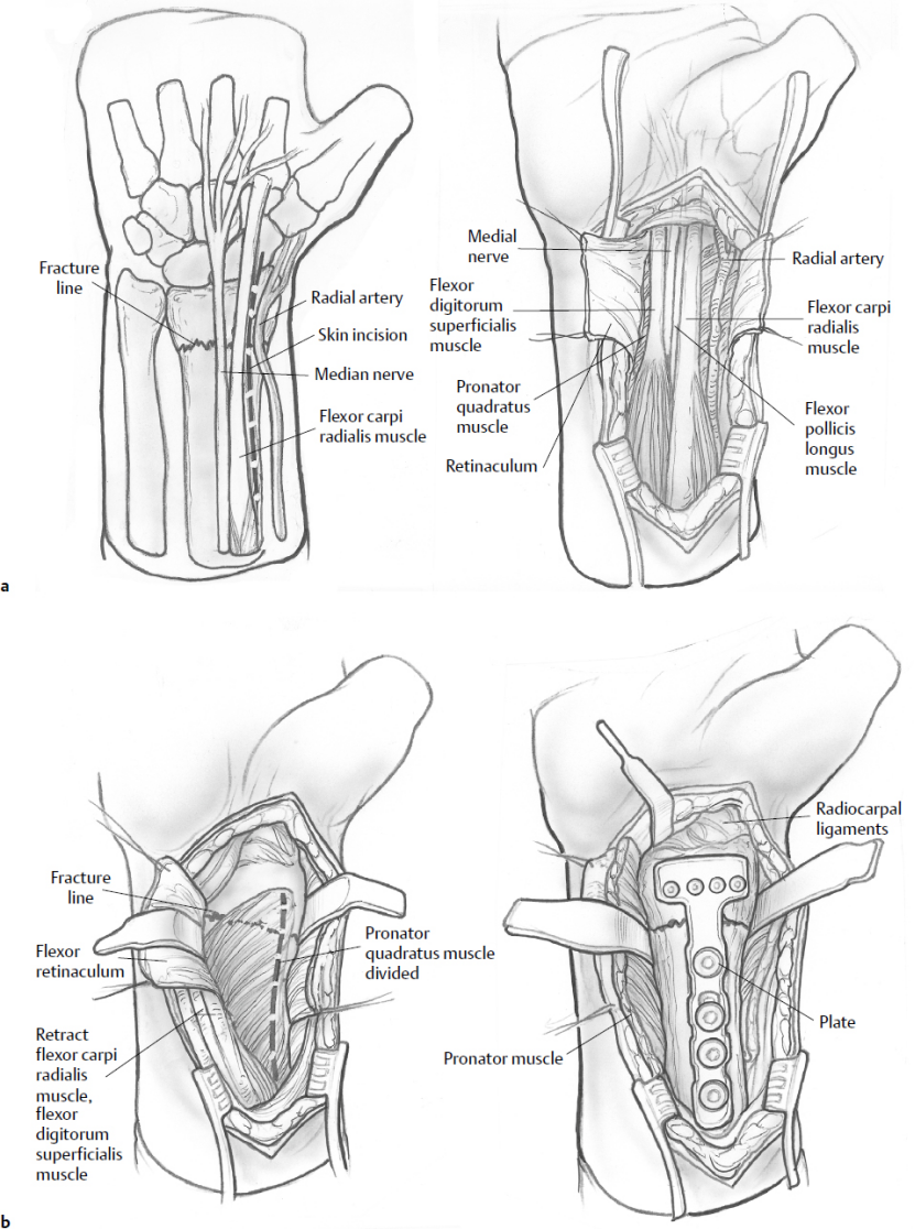 Extended flexor carpi radialis (FCR) approach