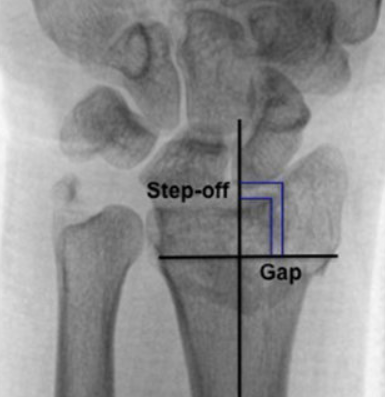 Intra articular step off and gap