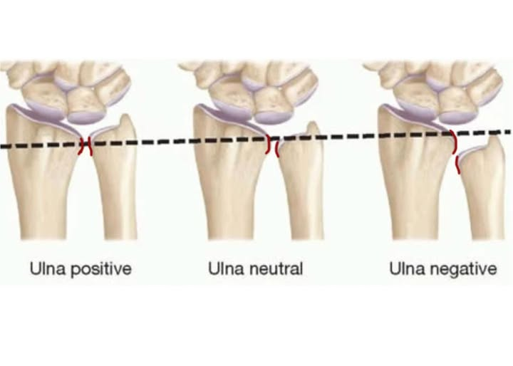 Ulnar variance