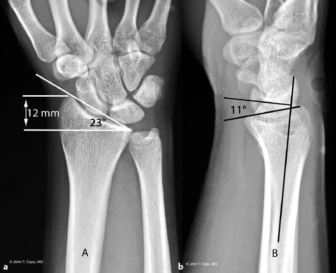 Volar tilt and Radial height