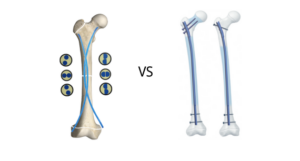Adolescent Lateral Entry Femoral Nail (ALFN) vs Elastic Stable Intramedullary Nailing (ESIN) in Pediatric Diaphyseal Femur Fractures