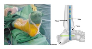 Salvage Hind-Foot Fusion Using a Tibiotalocalcaneal Intramedullary Nail