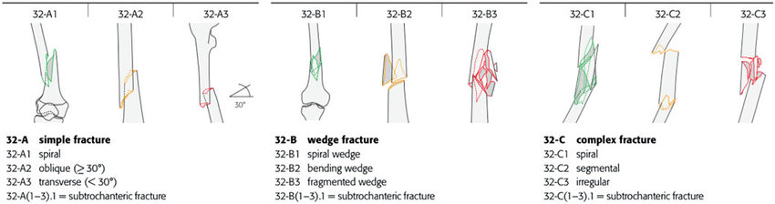 diaphyseal femur fractures