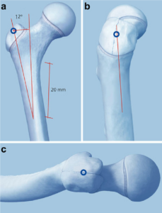 lateral to the tip of the trochanter