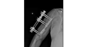 Home 16 methods for bone transport in humeral defect reconstruction